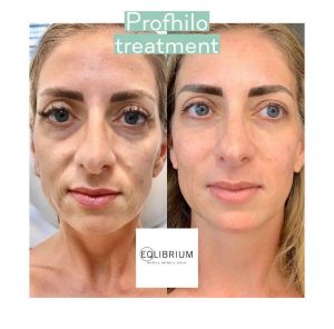 Profhilo Addlestone