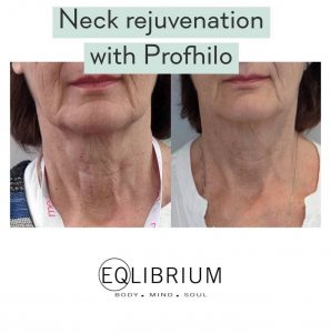 Profhilo in Surrey