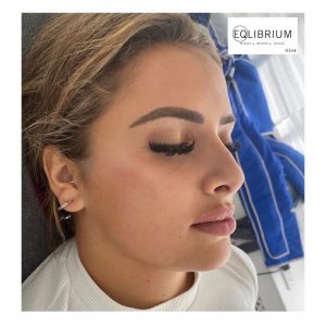 lip cheek filler weybridge