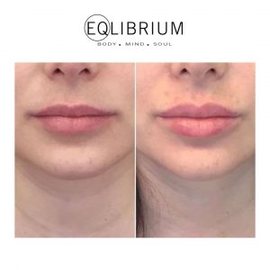 dermal filler Surrey