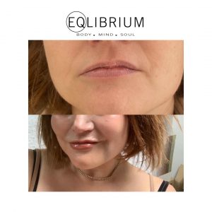 natural lips Weybridge 
