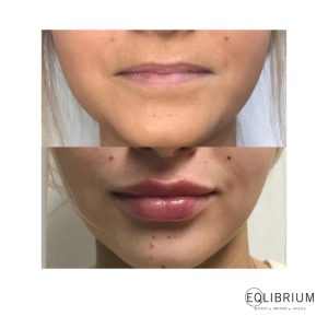 lip filler kt13
