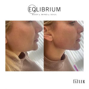 chin jaw filler Weybridge 