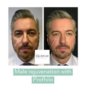skin booster weybridge