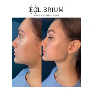 jaw filler Surrey kt13
