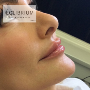 lip filler in Weybridge