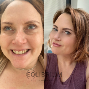 lip filler in weybridge