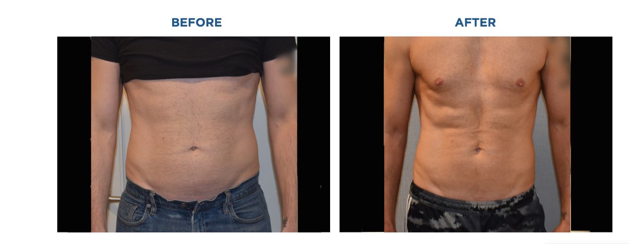 Ultrasound for Dermal Filler Complications