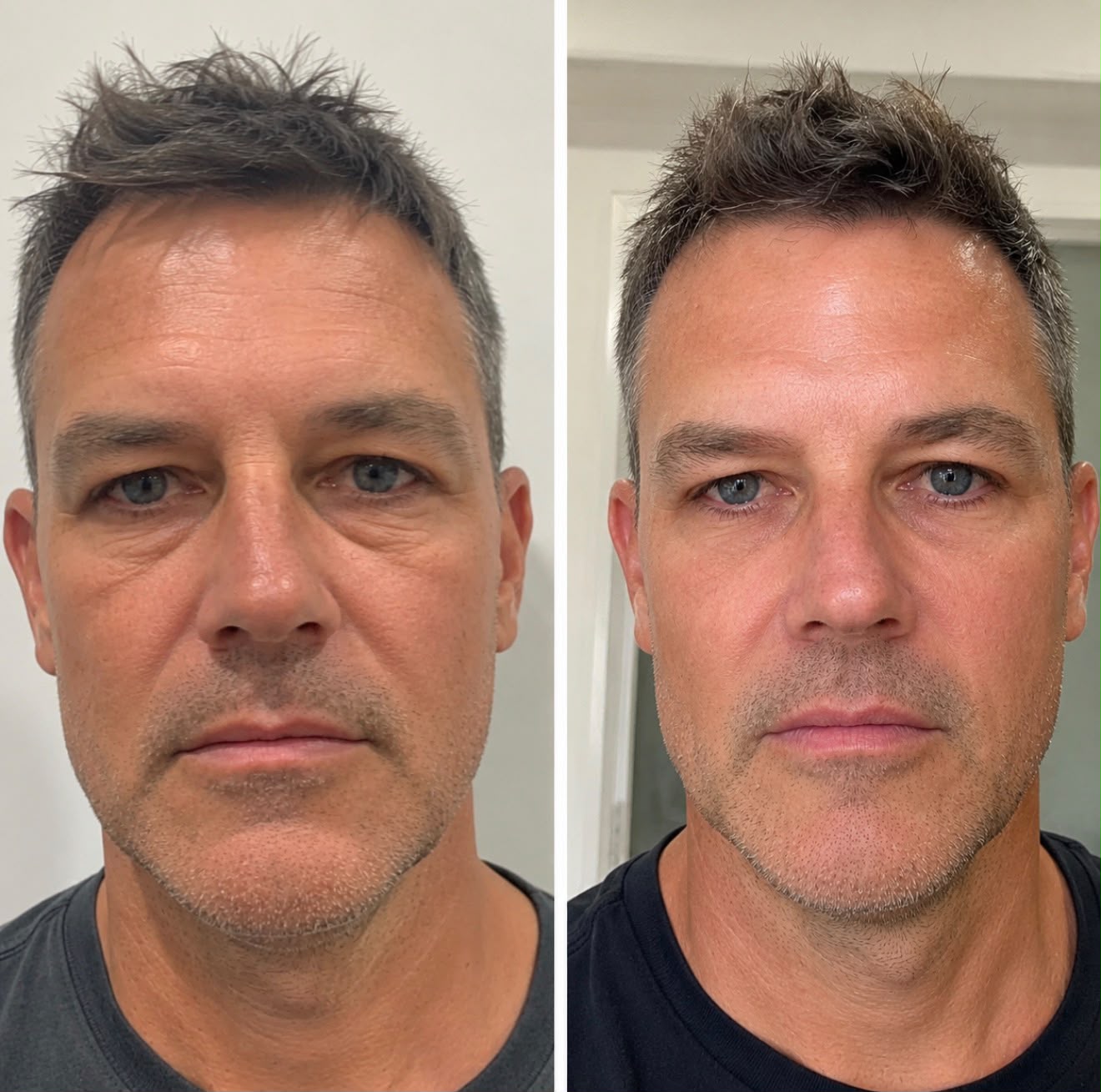 Age Rewind™ – The Next Generation of Natural Facial Rejuvenation in Surrey & Harley Street