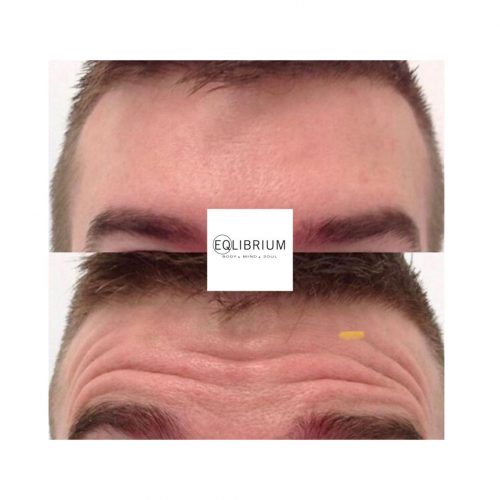 anti wrinkle Weybridge Surrey