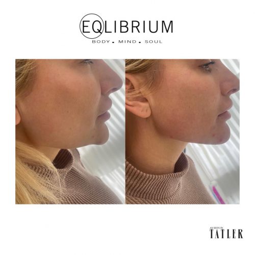 chin jaw filler Weybridge
