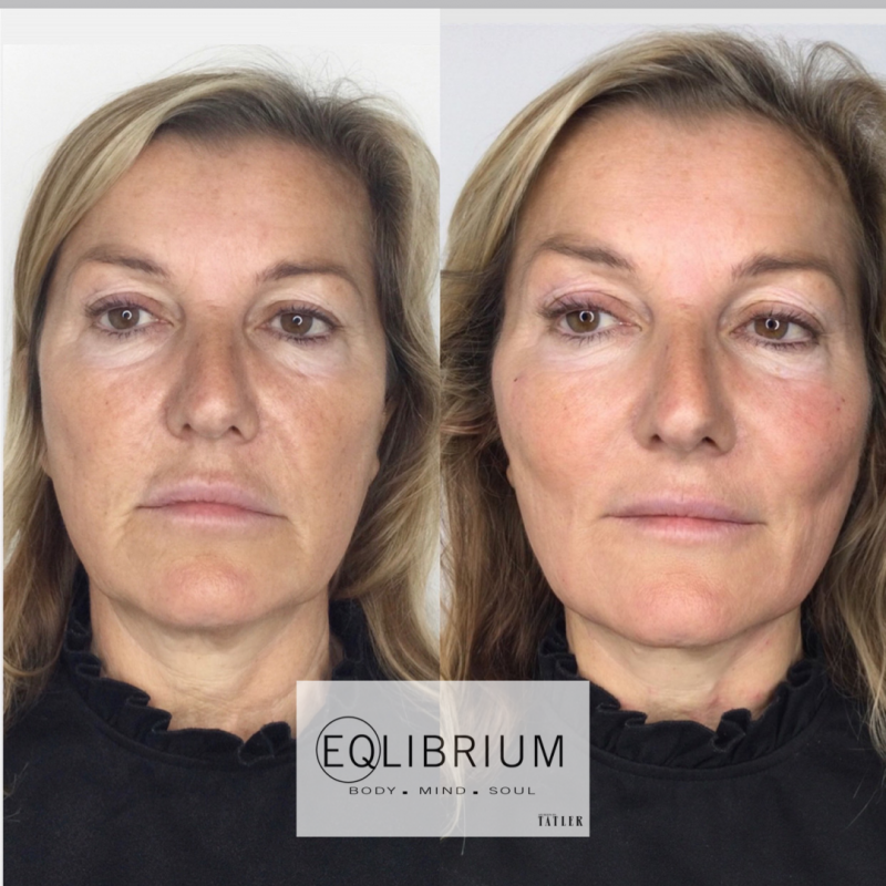 pro thread lift Weybridge