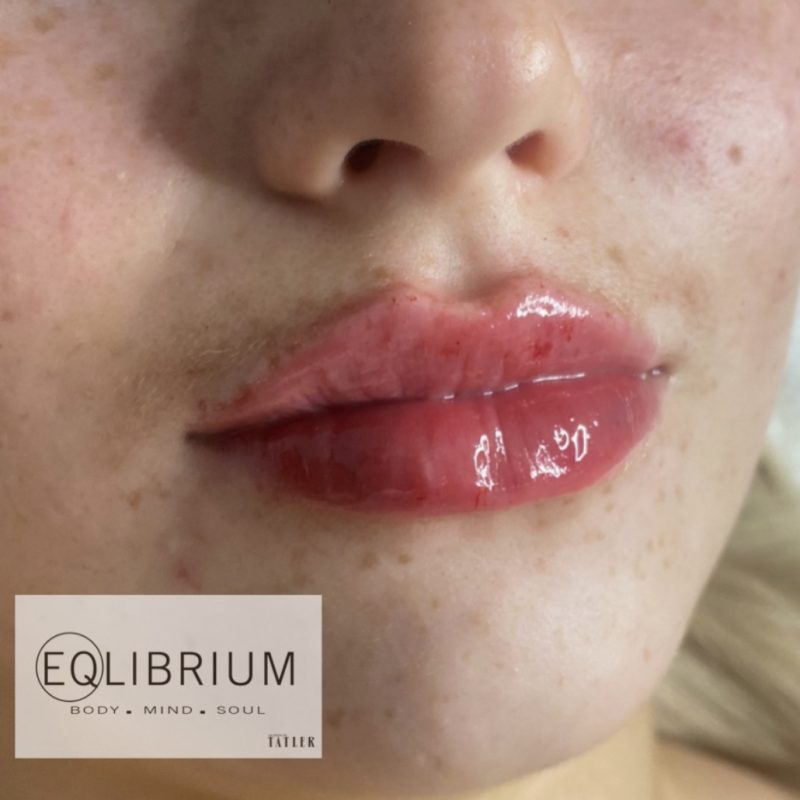 lip filler in weybridge Surrey