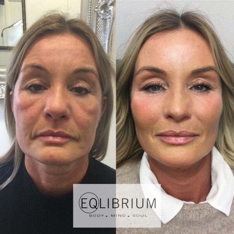 Non-surgical facelift in London with EQlibrium copper peptide serum for natural anti-aging results