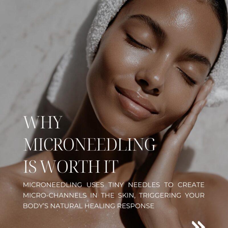 microneedling surrey rf exosome skin treatment