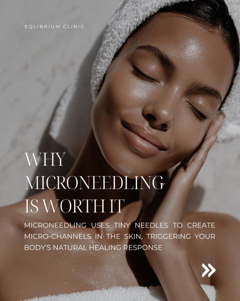 microneedling surrey rf exosome skin treatment
