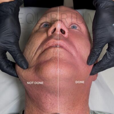endolift 1