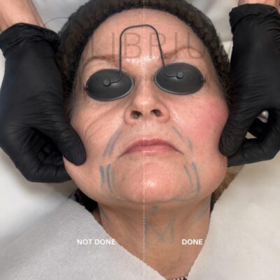 endolift 2