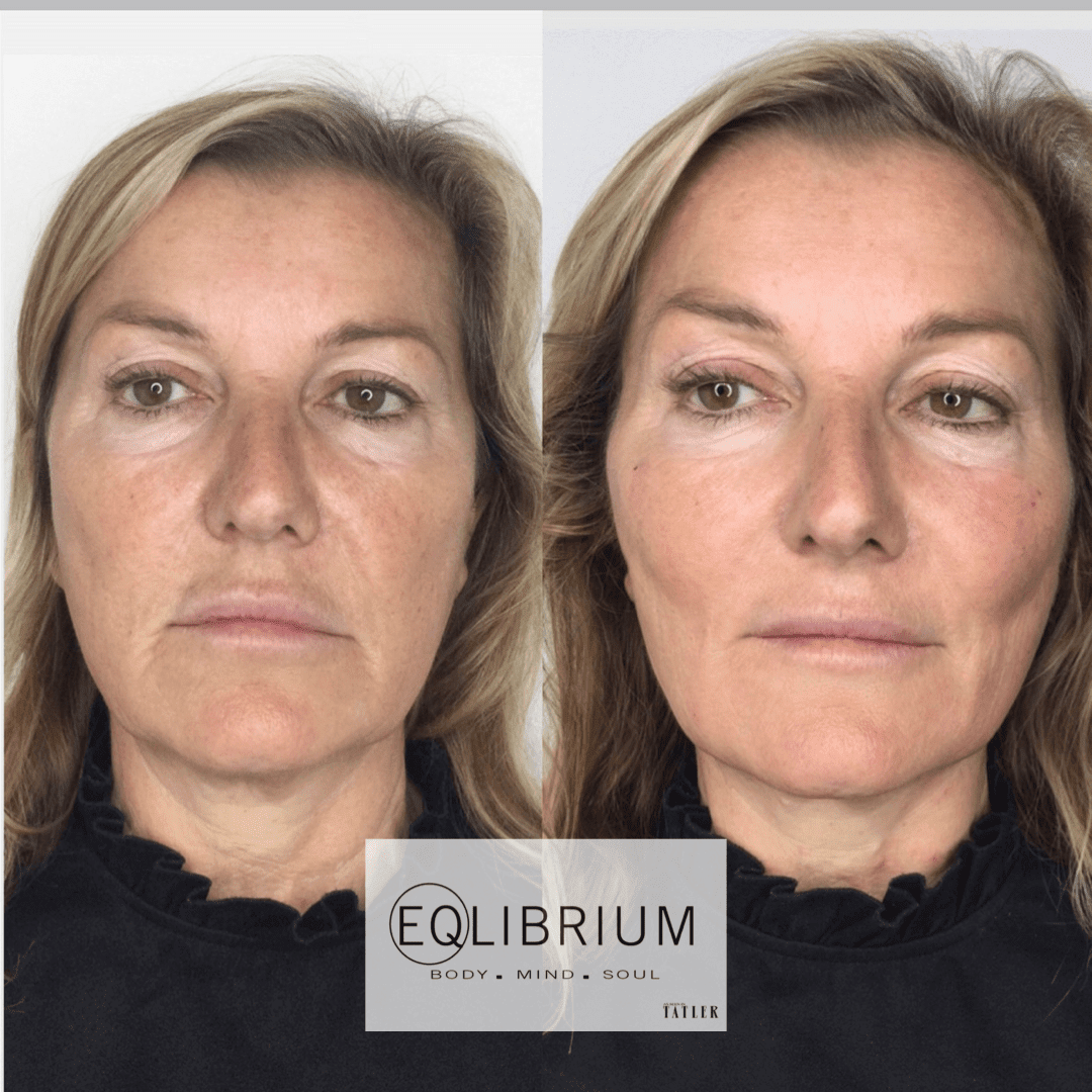 pro thread lift Weybridge